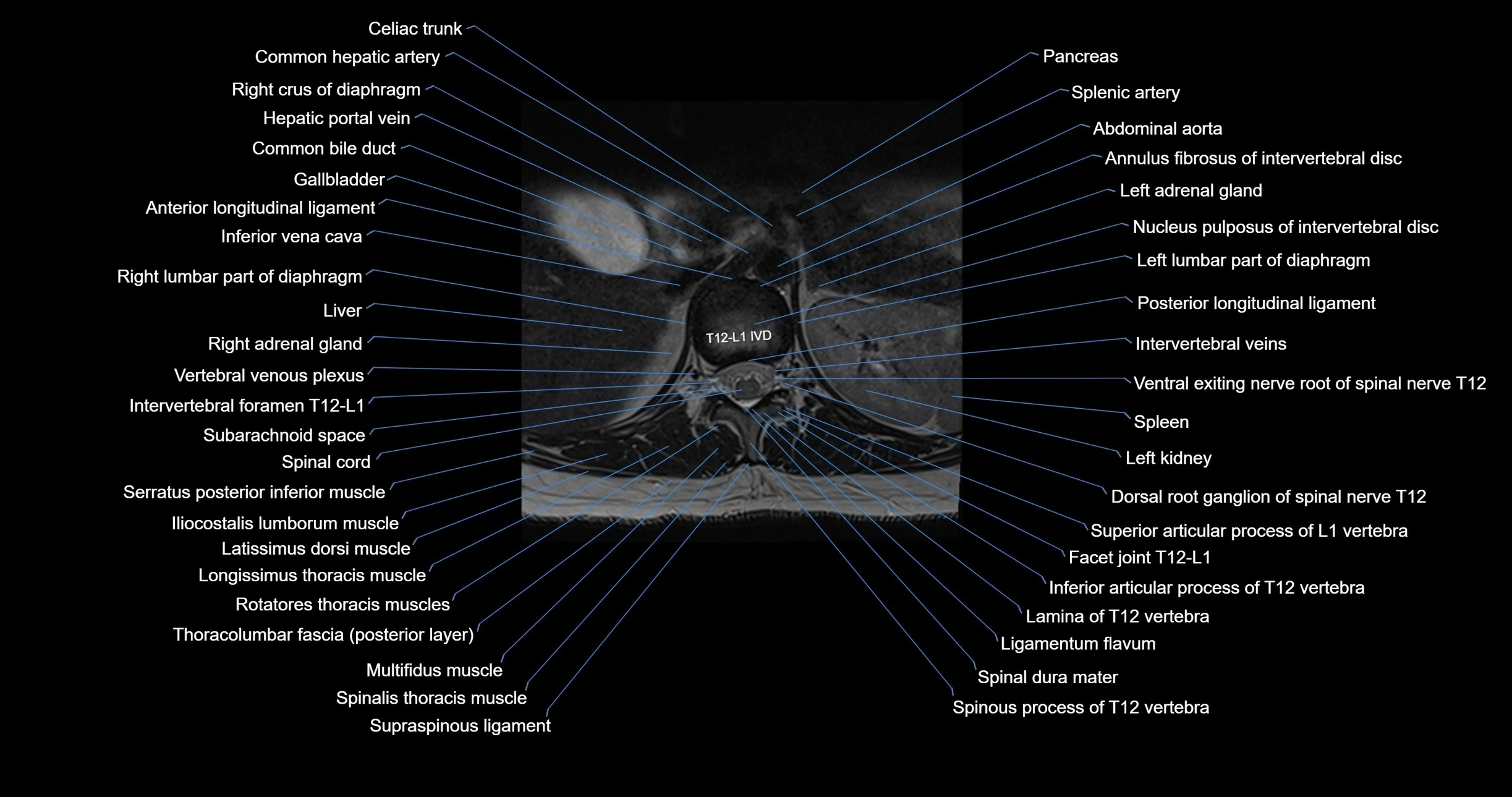 MRI lumbar spine axial cross sectional anatomy 3T radiology  image-img-00001-00004.webp